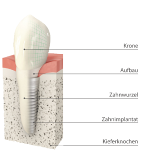 Detalierter Aufbau eines Zahnimplantats