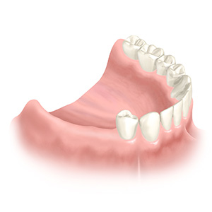 Mehrere Zähne fehlen im Seitenbereich